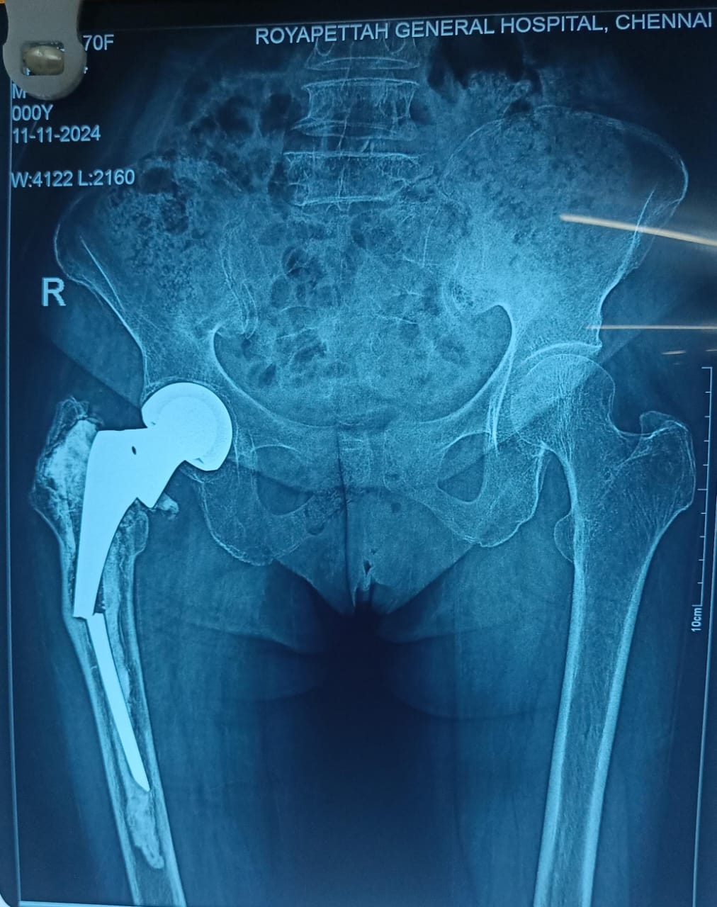 70 year old female with cemented fixed bipolar done about 8 years ago. Now presents with such a scenario.